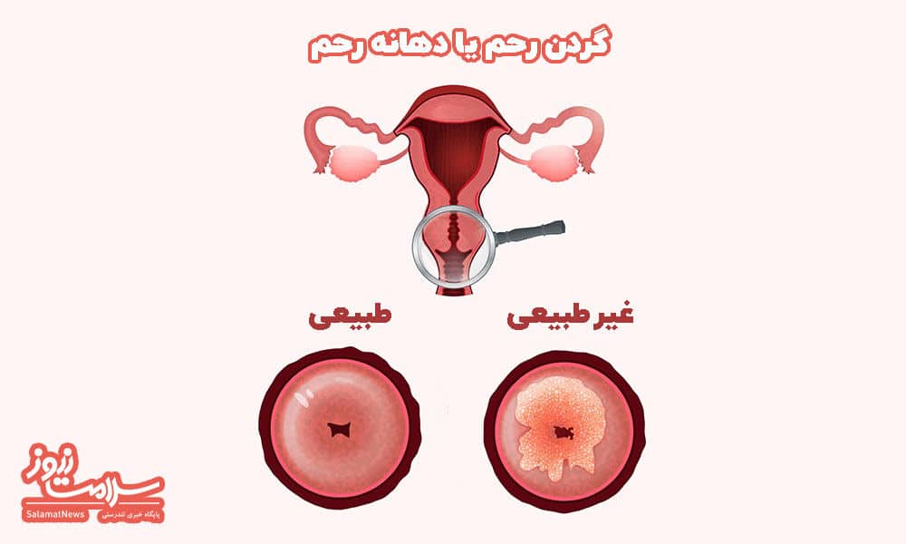نحوه انجام آزمایش پاپ اسمیر نحوه انجام آزمایش پاپ اسمیر