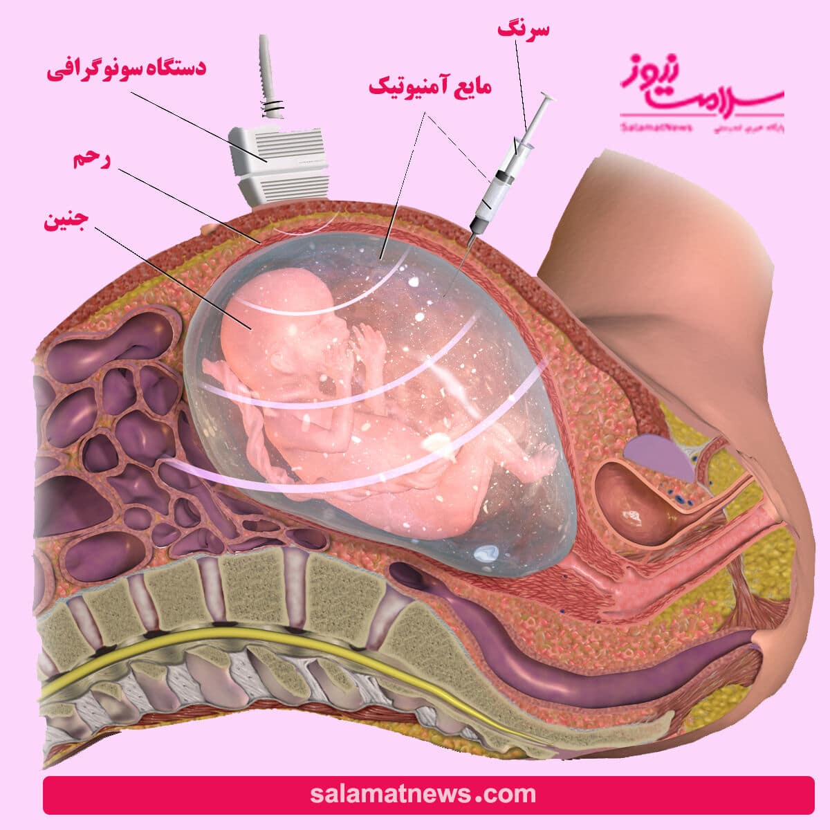 آمنیوسنتز چیست آمنیوسنتز چیست