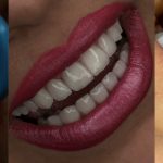 بهترین و سریع ترین روش های زیبایی دندان