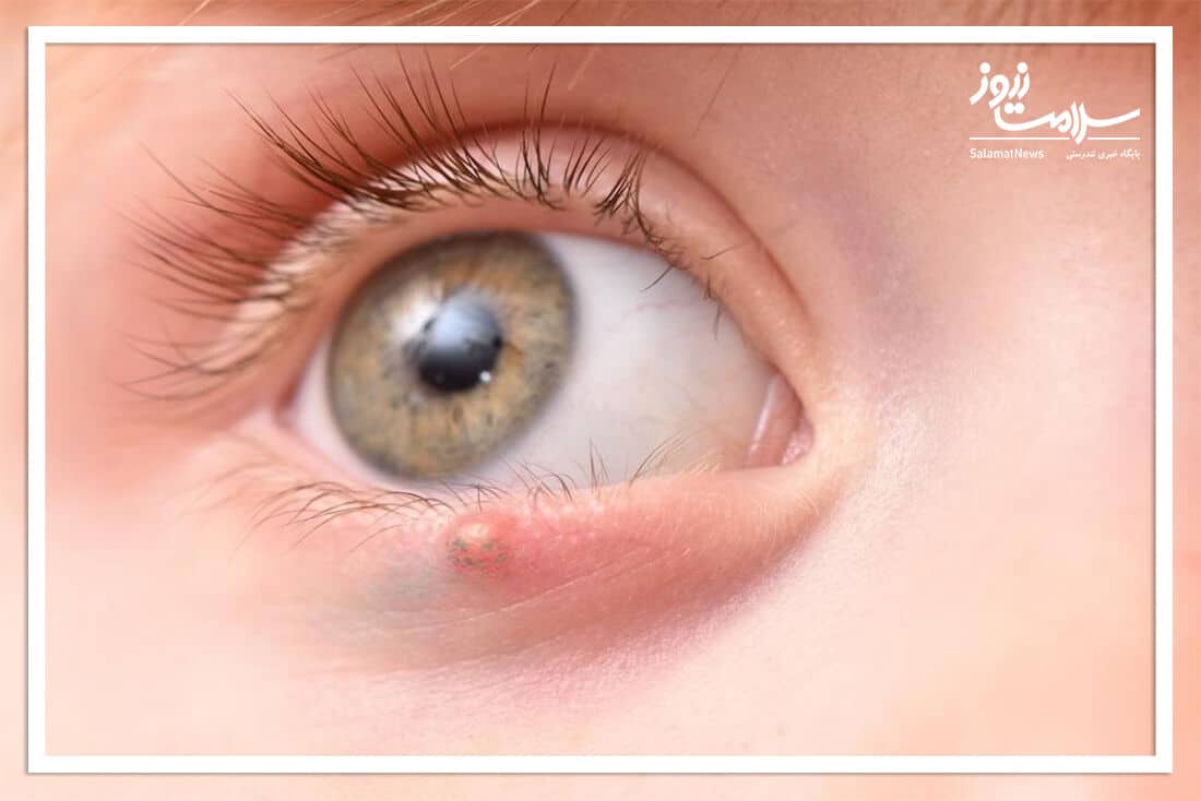 گل مژه در کودکان: انواع، علائم، علل و درمان گل مژه در کودکان: انواع، علائم، علل و درمان