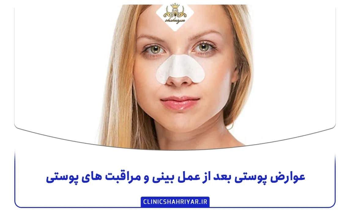 عوارض پوستی بعد از عمل بینی و مراقبت های پوستی عوارض پوستی بعد از عمل بینی و مراقبت های پوستی