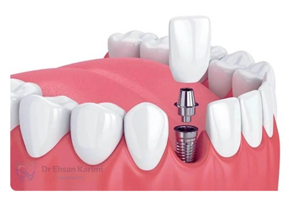 کاشت ایمپلنت دندان در مشهد با روش های دیجیتال