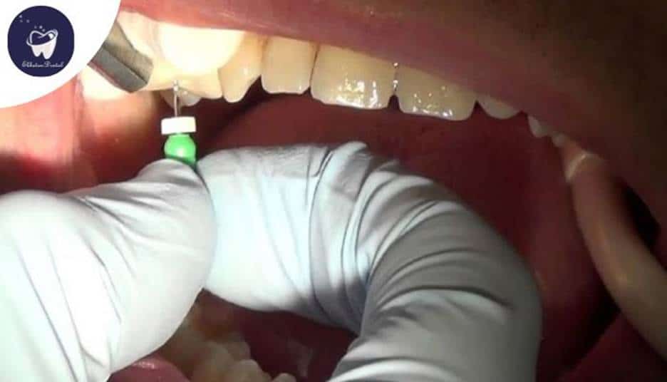 آیا ممکن است عفونت ریشه دندان پس از عصب‌کشی برگردد؟