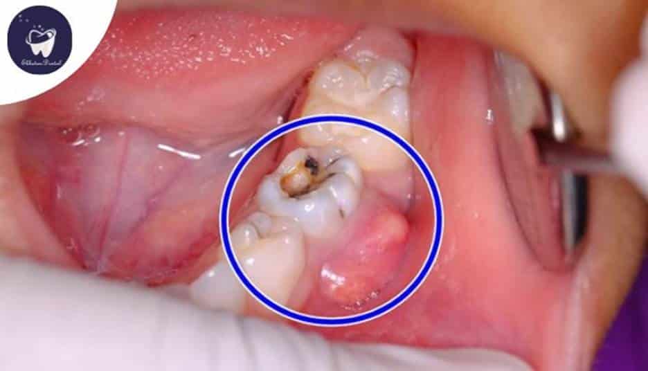 آیا ممکن است عفونت ریشه دندان پس از عصب‌کشی برگردد؟