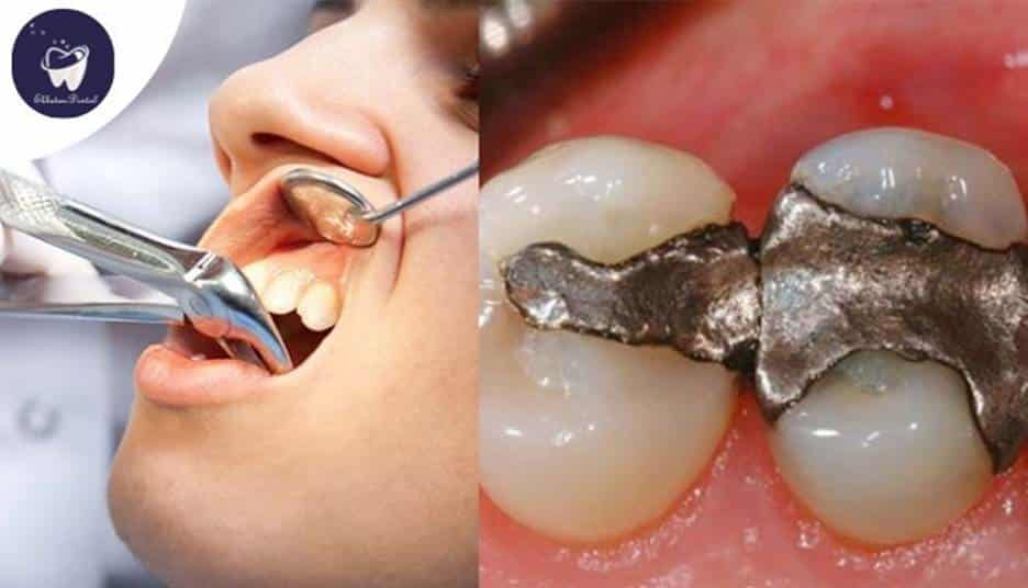 آیا ممکن است عفونت ریشه دندان پس از عصب‌کشی برگردد؟