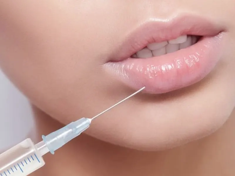 فیلر لب