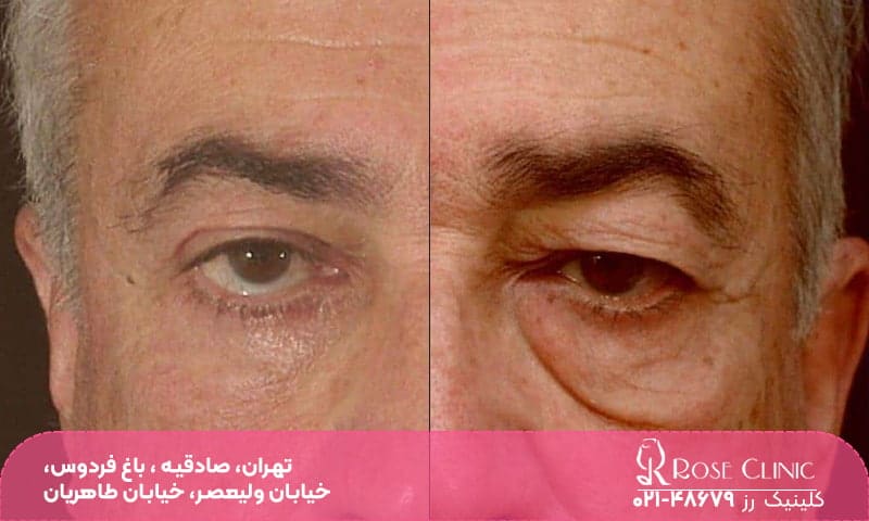 آیا عمل بلفاروپلاستی خطرناک است؟