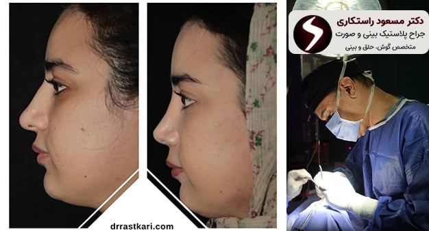 همه‌چیز درباره عمل بینی با عوارض کم؛ از انتخاب جراح تا تکنیک مناسب