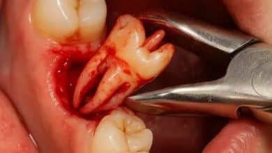 مواد بی حسی دندانپزشکی روزه را باطل می کند؟ مواد بی حسی دندانپزشکی روزه را باطل می کند؟