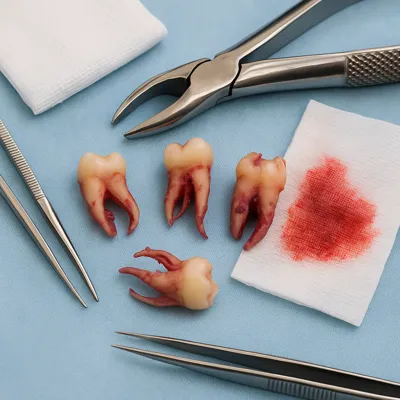 ریشه‌های پیچیده دندان نهفته بعد از کشیدن روی ست جراحی