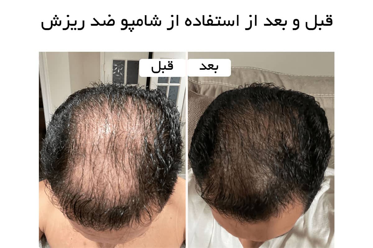 آیا شامپوهای ضد ریزش واقعا تاثیر دارند؟