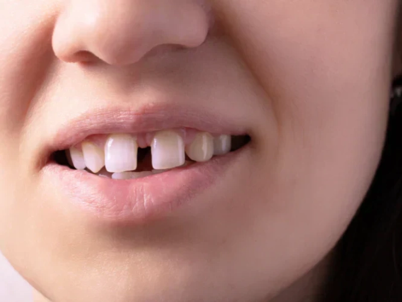 دلایل بستن فاصله بین دندان