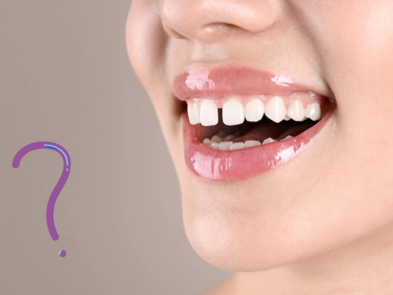 بهترین روش بستن فاصله بین دندان