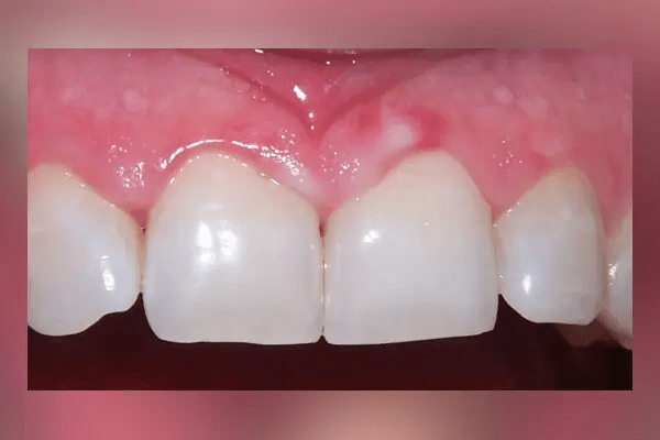 سوختگی لثه بعد از بلیچینگ