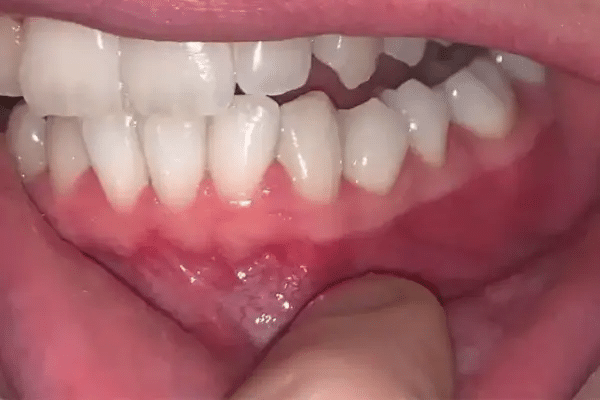 سوختگی لثه بعد از بلیچینگ