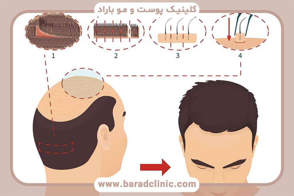 چگونه کاشت مو می‌تواند چهره را جوان کند؟