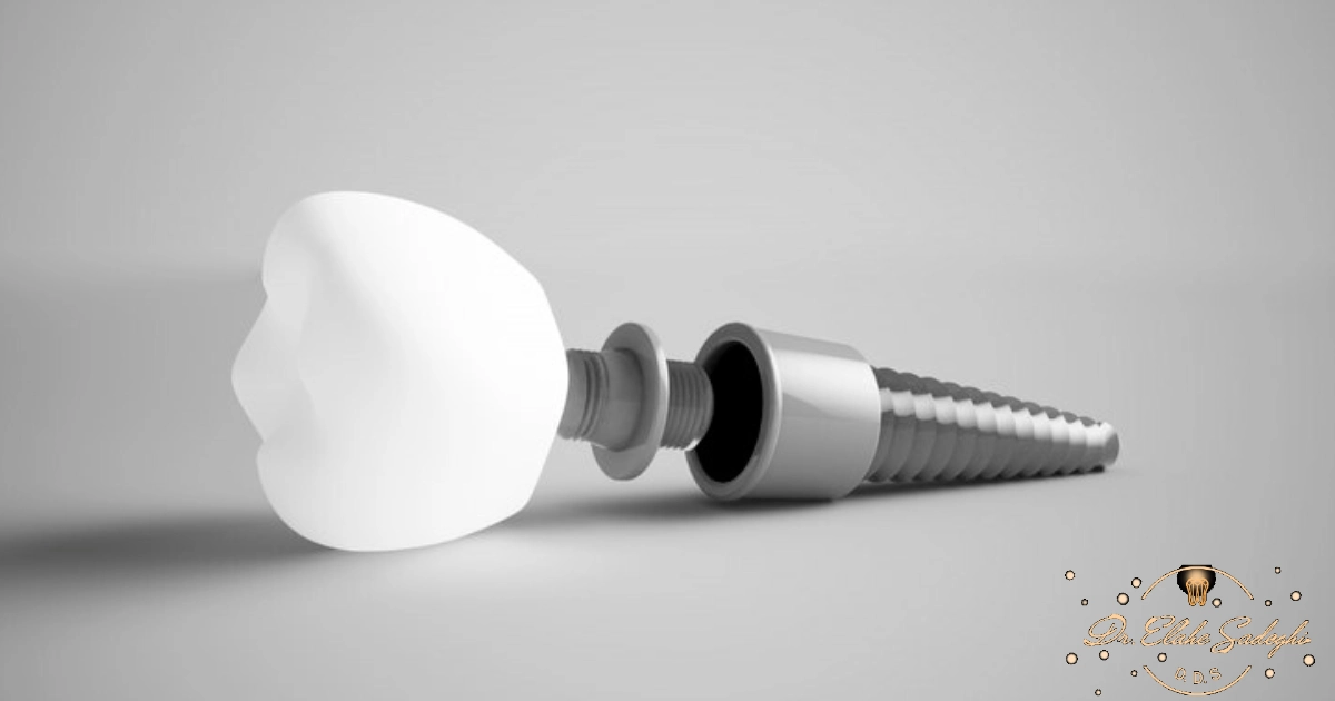 ایمپلنت پانچی