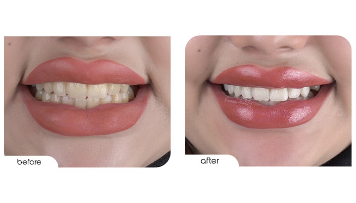 نمونه کار بلیچینگ با لیزر در مشهد