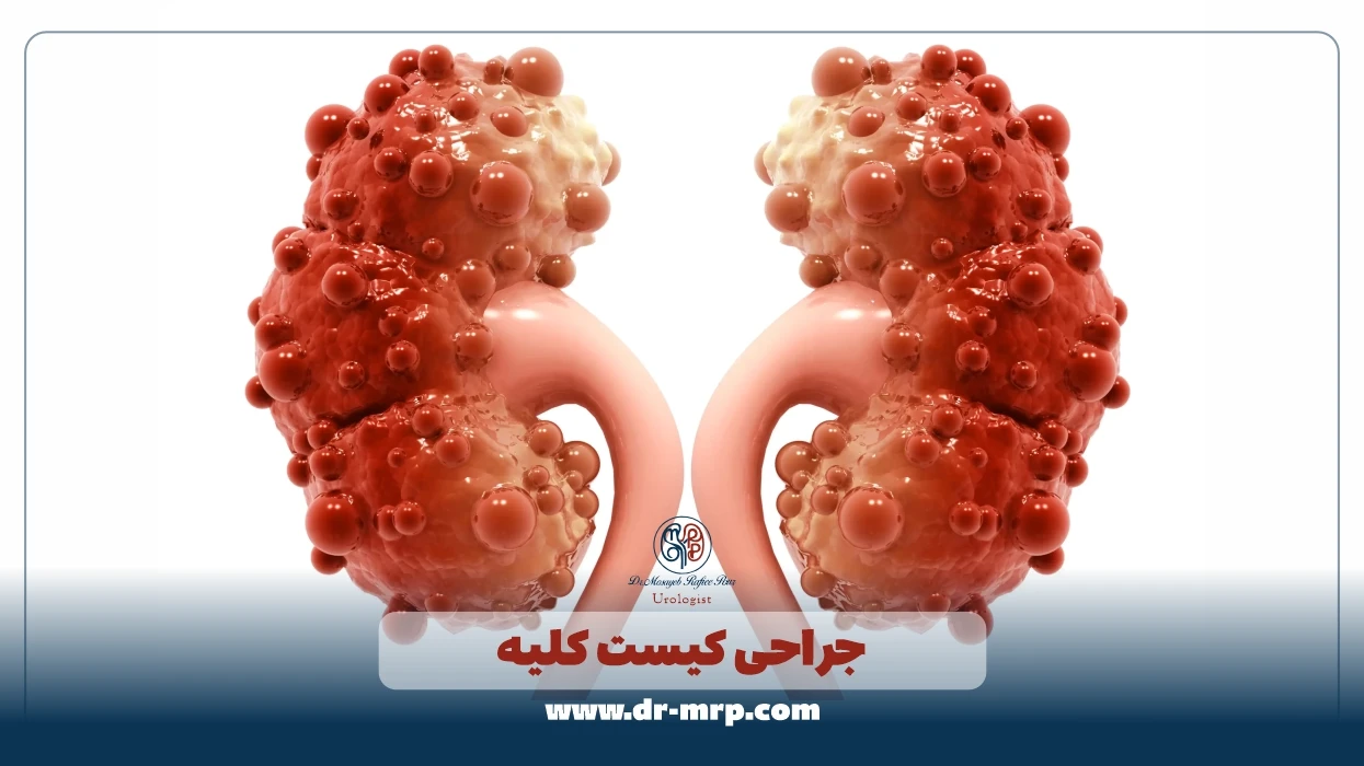 جراحی کیست کلیه