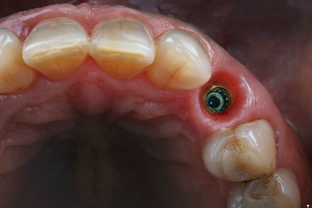 مراحل رایج ایمپلنت به زبان ساده