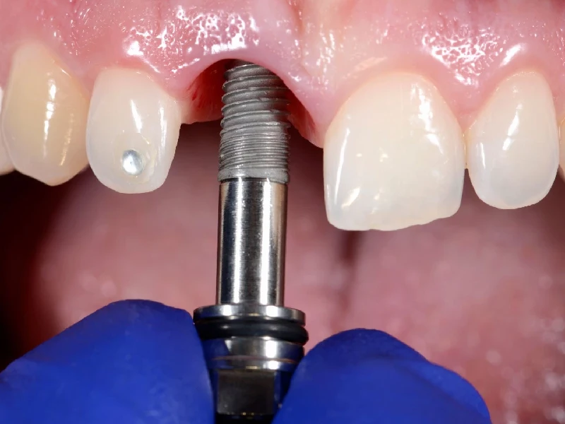 نمایی نزدیک از ایمپلنت دندان