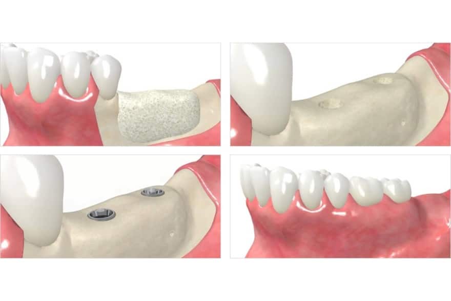 بازسازی استخوان فک برای کاشت ایمپلنت دندان