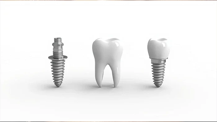 chinese implant fixtures and brnds and crownss ایمپلنت های چینی برندهای برتر جراحی کاشت ایمپلنت فیکسچر اباتمنت
