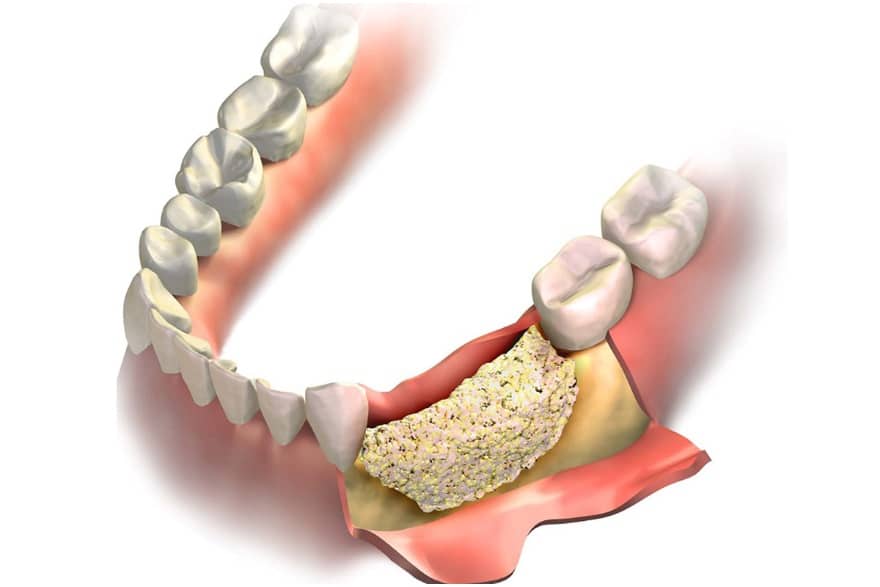 بازسازی استخوان فک برای کاشت ایمپلنت دندان