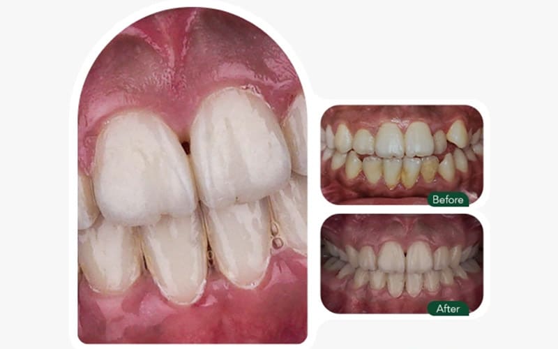 نتیجه ارتودنسی دندان در کلینیک بارانا مشهد