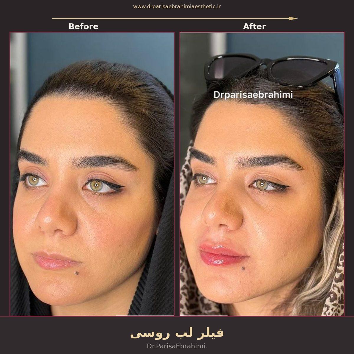 نمونه فیلر لب با تکنیک روسی در کلینیک نیاوران تهران