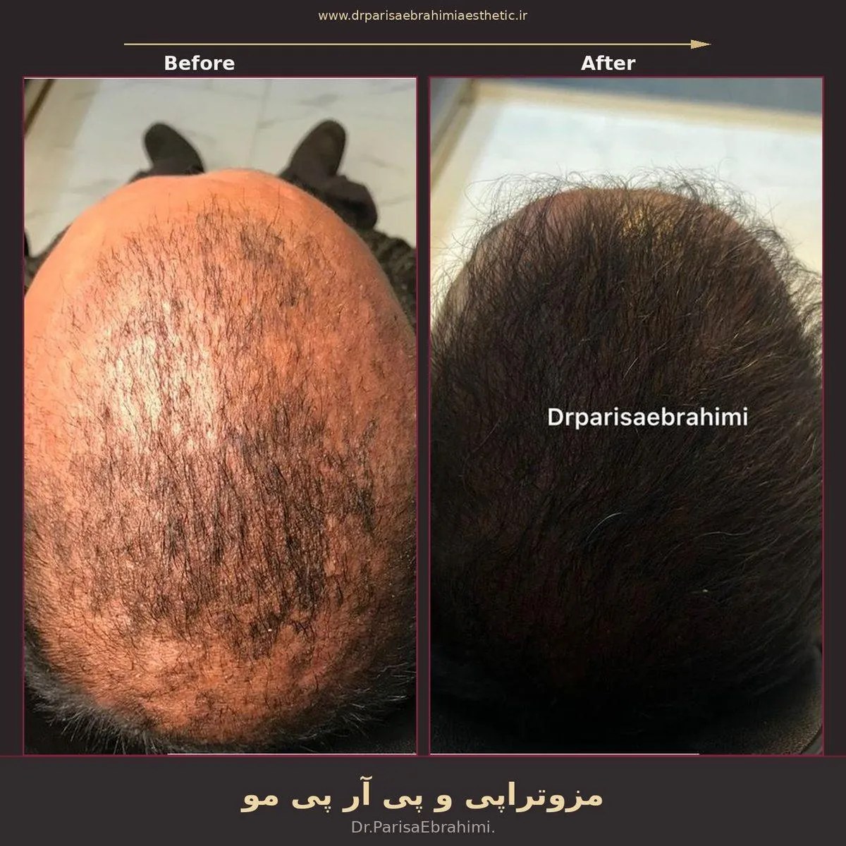 نمونه مزوتراپی مو و PRP در کلینیک دکتر پریسا ابراهیمی تهران