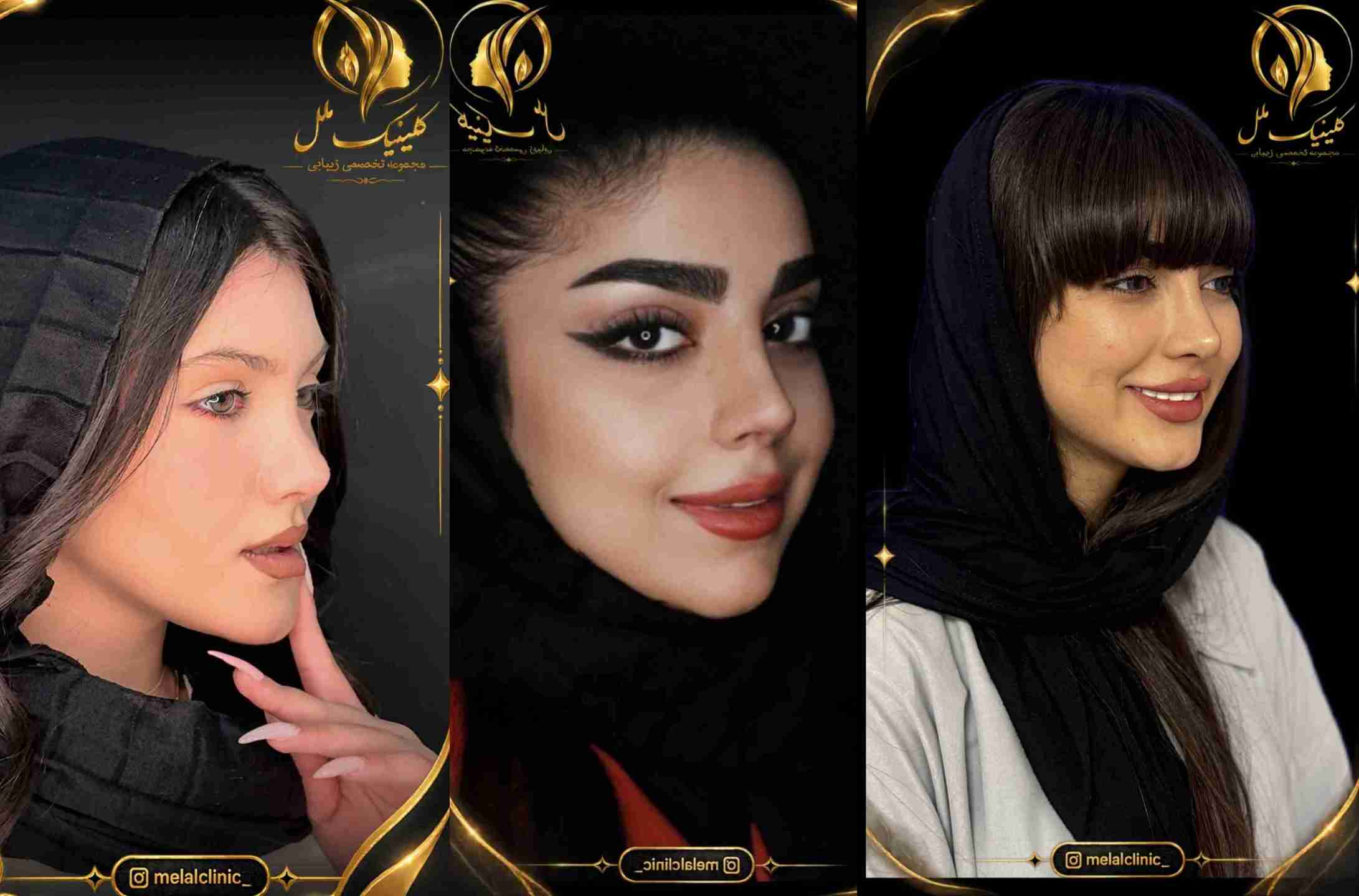 نمونه کار واقعی جراح پلاستیک بینی در تهران
