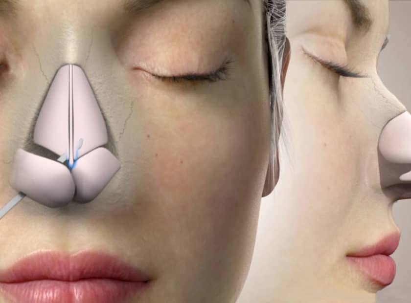 چگونه جراح بینی را انتخاب کنیم؟ 7 معیار مهم قبل از رینوپلاستی