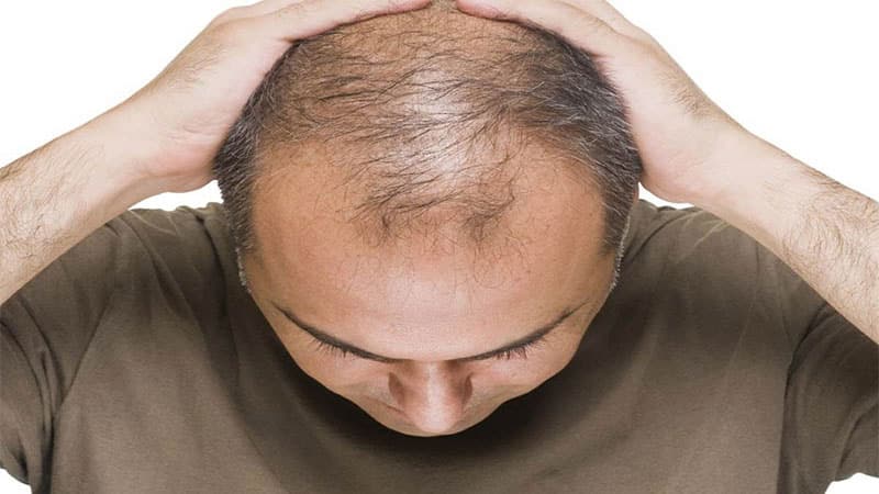 ریزش مو؛ از علتها تا راهکارهای درمانی